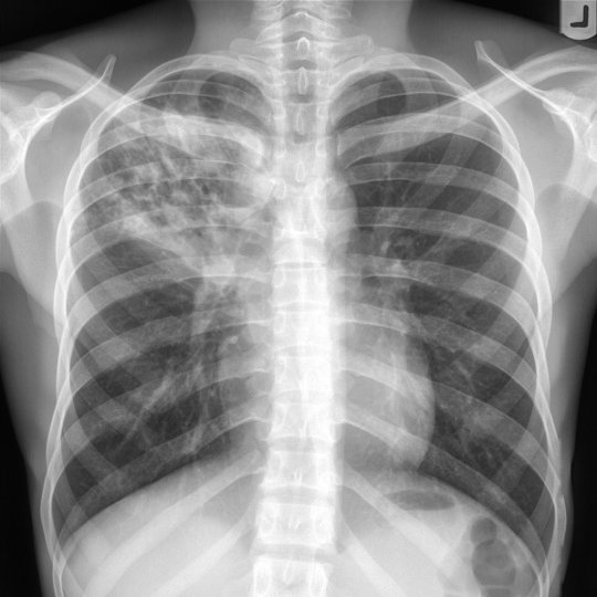 PA chest radiograph demonstrating a thick-walled right upper lobe cavitary mass consistent with a diagnosis of tuberculosis (taken by a portable x-ray machine)