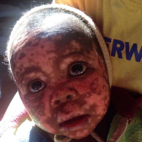 Generalized crusting rash most prominent on the face.......thought by the teledermatologist to be neonatal lupus eryththatosus