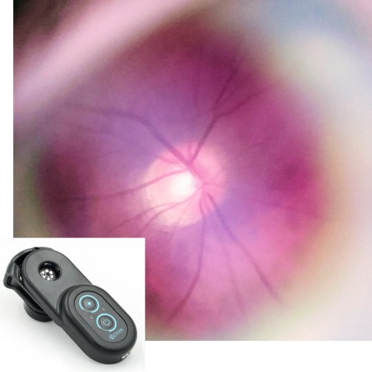 Example image of a healthy fundus acquired using Peek Retina (left) under dilation