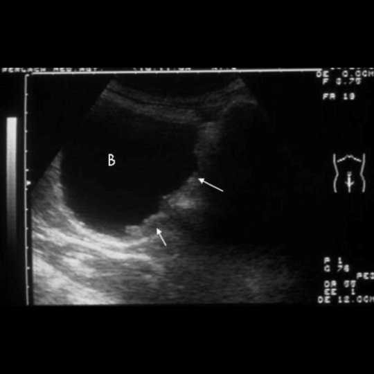 A portable ultrasound scan demonstrating irregular thickening (arrows) of the bladder (B) wall due to polypoid protrusions as a result of schistosomiasis