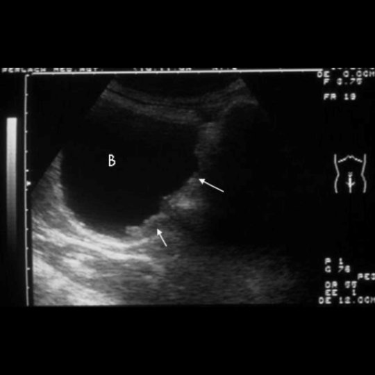 A portable ultrasound scan demonstrating irregular thickening (arrows) of the bladder (B) wall due to polypoid protrusions as a result of schistosomiasis