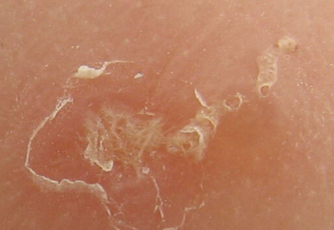 Scabies - mite borrowed into skin - image: Wiki Commons