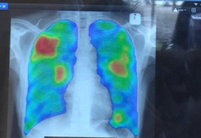 CAD CXR Credit: Peter MacPherson