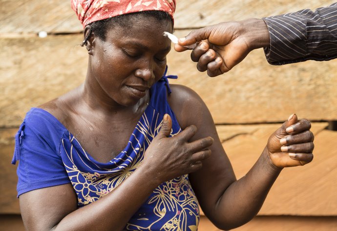 Credit: Elssie Ansareo/Anesvad Caption: “Close your eyes and let me know if you feel this”. A senior field technician for leprosy in Ghana starts diagnosis through the skin sensation test