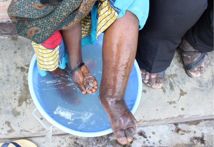 A woman with podoconiosis washes her feet. Photo: Dr Kebede Deribe