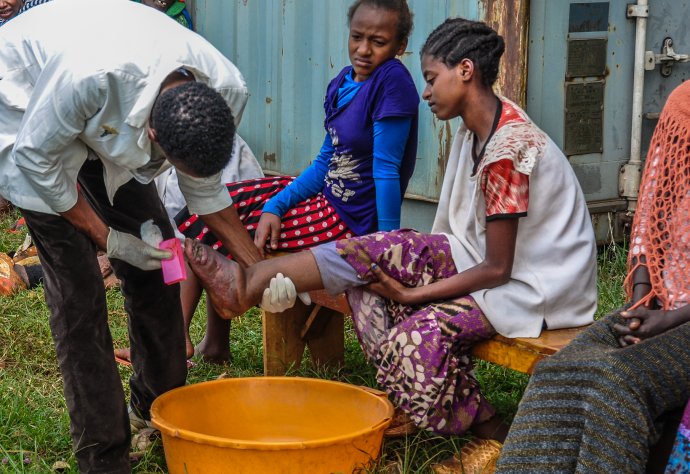 The simple treatment of podoconiosis. Tigist is successfully treated and goes back to school now. Photo: Jelle Visser