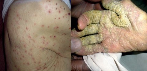 Scabies presentations from our UK care home study (Cassell et al, Lancet Infectious Diseases, 2018)