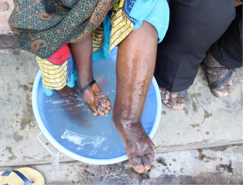 © Kebede Deribe A woman in Rwanda with elephantiasis washes her legs as part of the WHO-recommended morbidity management and disability prevention for podoconiosis and lymphatic filariasis.