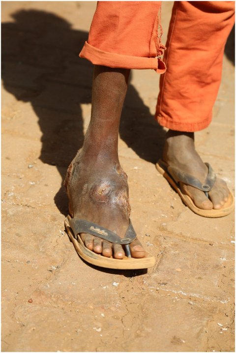 Mycetoma affects the foot of a young boy  Mycetoma affects the foot of a young boy