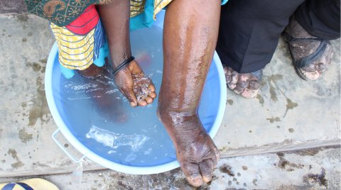 A woman with podoconiosis washes her foot. Photo: Dr Kebede Deribe A woman with podoconiosis washes her foot. Photo: Dr Kebede Deribe