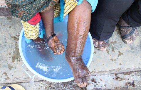 A woman with podoconiosis washes her foot. Photo: Dr Kebede Deribe