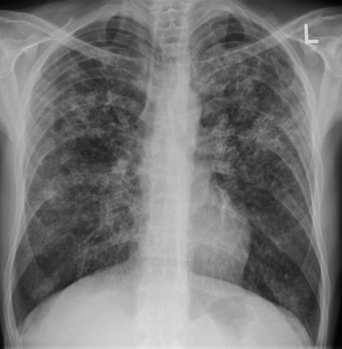 A patient with TB credit James Heilman, MD