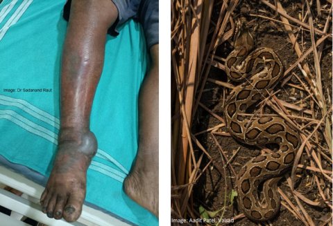A typical viper bite (Russell’s Viper) farmers suffer when walking barefoot in the fields.